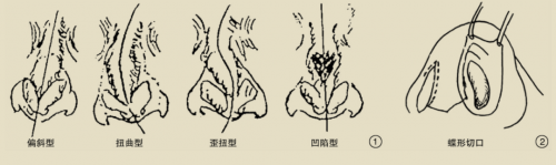 郑州东方整形李冰鼻整形技术